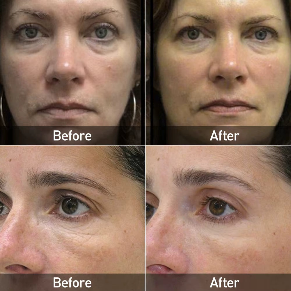 Masque LED Luminothérapie Visage - Anti-Rides Rajeunissement Peau