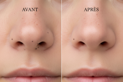 Appareil facial - Avant/Après narines et pores