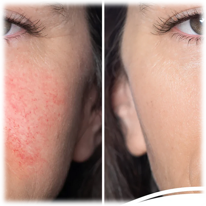 Masque LED de Luminothérapie Rechargeable - 7 Couleurs Anti-Acné et Rajeunissement